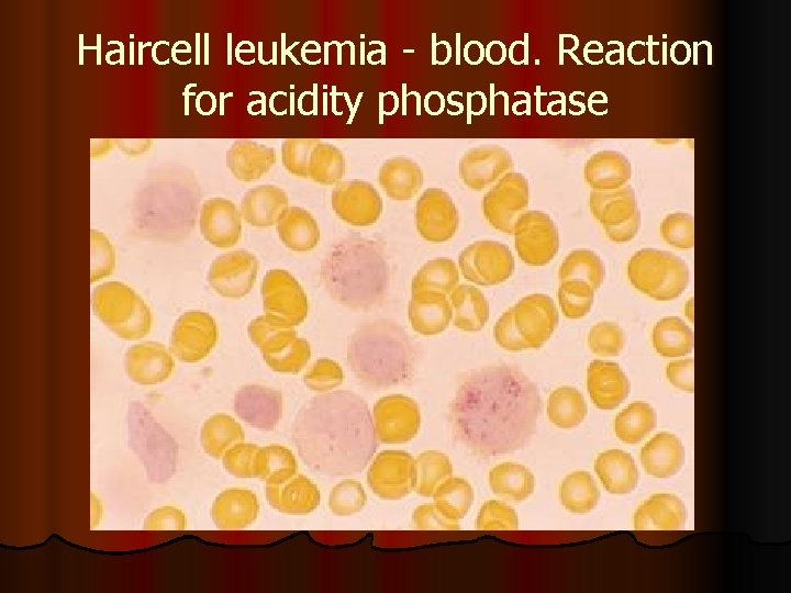 Haircell leukemia - blood. Reaction for acidity phosphatase 