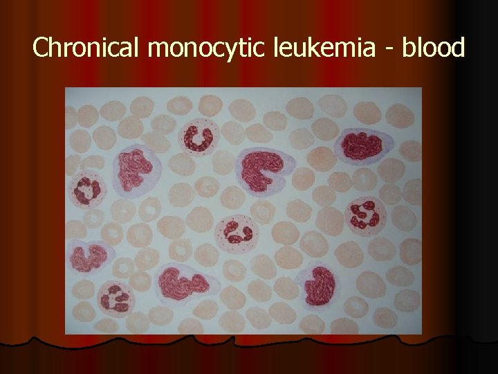 Chronical monocytic leukemia - blood 
