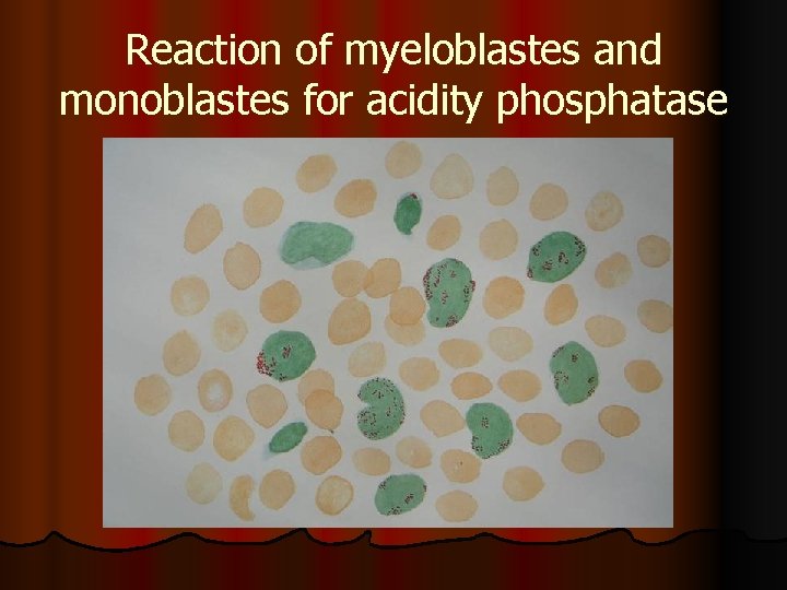 Reaction of myeloblastes and monoblastes for acidity phosphatase 