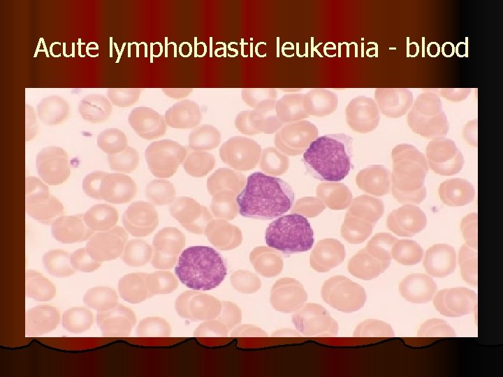 Acute lymphoblastic leukemia - blood 
