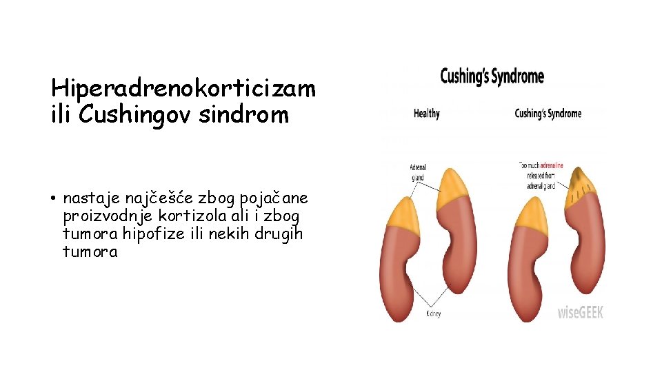 Hiperadrenokorticizam ili Cushingov sindrom • nastaje najčešće zbog pojačane proizvodnje kortizola ali i zbog