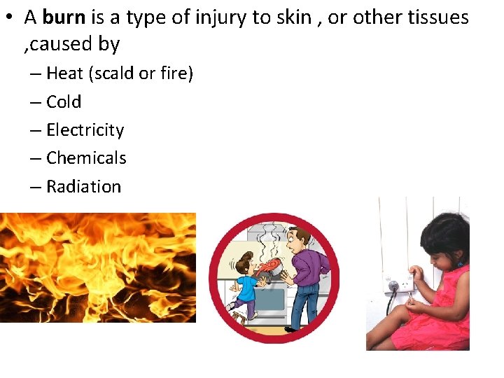  • A burn is a type of injury to skin , or other