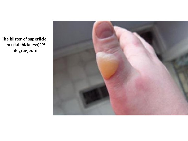 The blister of superficial partial thickness(2 nd degree)burn 