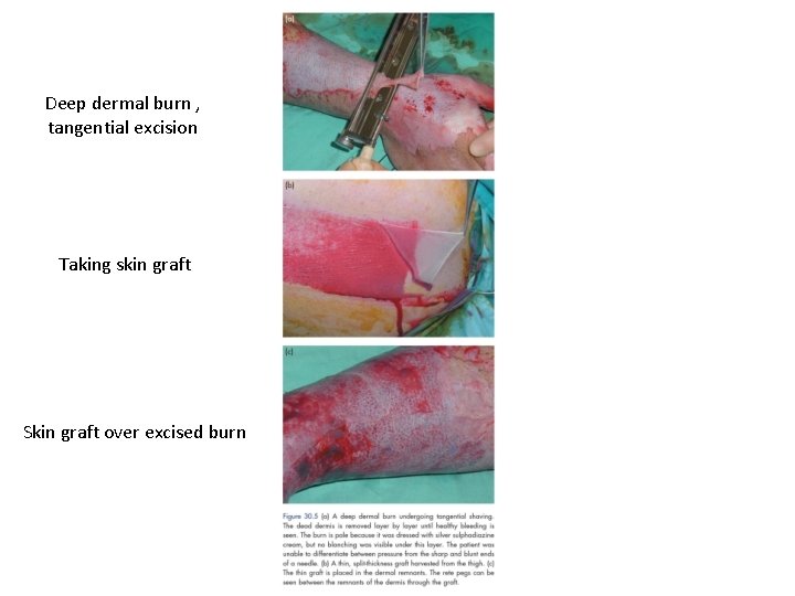 Deep dermal burn , tangential excision Taking skin graft Skin graft over excised burn