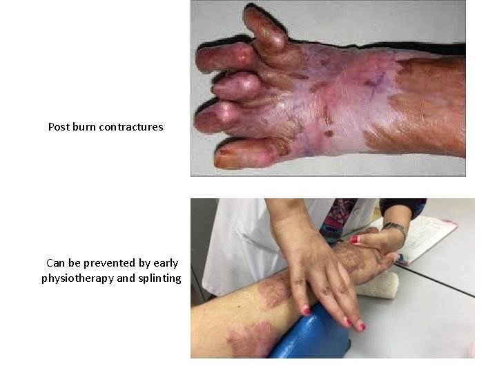 Post burn contractures Can be prevented by early physiotherapy and splinting 