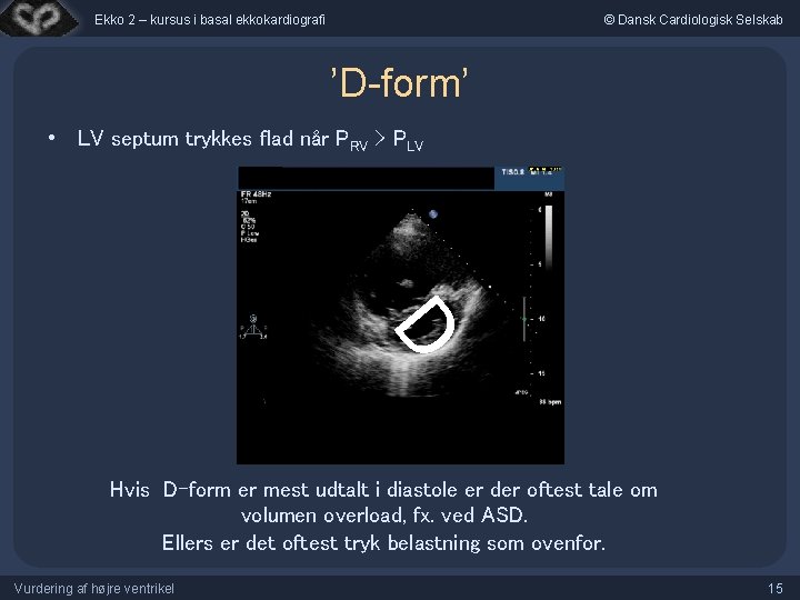 Ekko 2 – kursus i basal ekkokardiografi © Dansk Cardiologisk Selskab ’D-form’ • LV