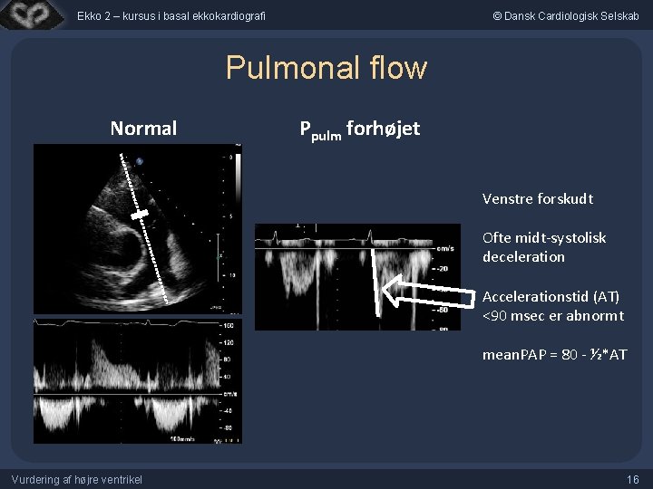 Ekko 2 – kursus i basal ekkokardiografi © Dansk Cardiologisk Selskab Pulmonal flow Normal