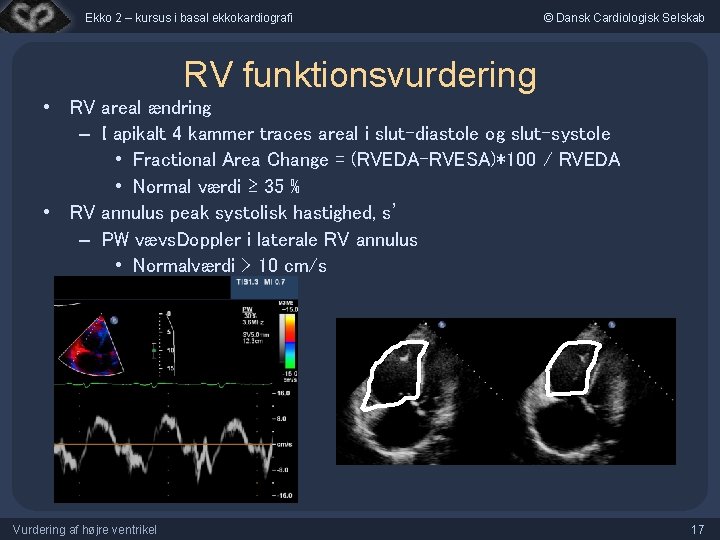 Ekko 2 – kursus i basal ekkokardiografi © Dansk Cardiologisk Selskab RV funktionsvurdering •