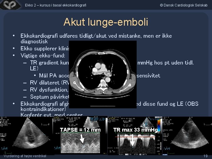 Ekko 2 – kursus i basal ekkokardiografi © Dansk Cardiologisk Selskab Akut lunge-emboli •