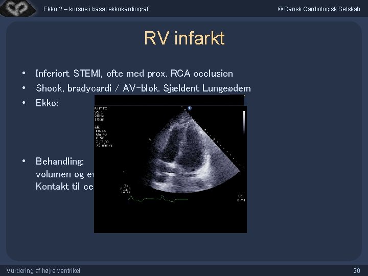 Ekko 2 – kursus i basal ekkokardiografi © Dansk Cardiologisk Selskab RV infarkt •