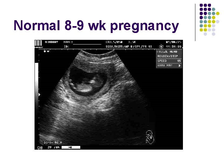 Normal 8 -9 wk pregnancy 