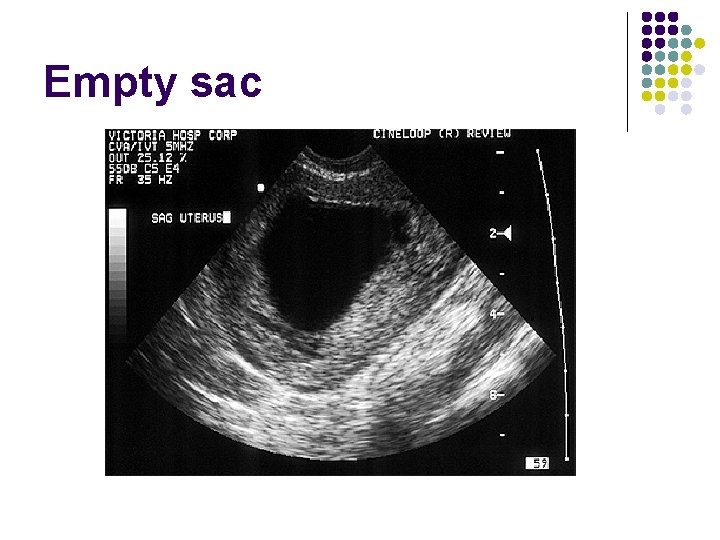 Empty sac 