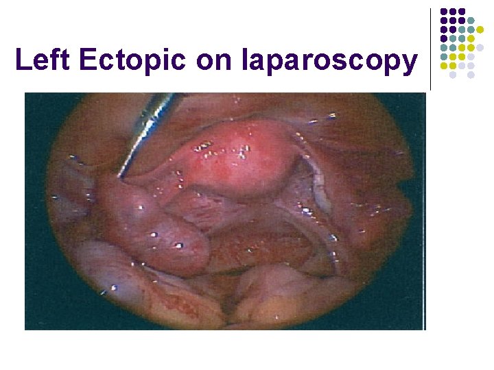 Left Ectopic on laparoscopy 