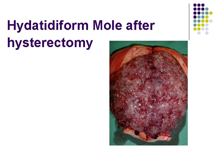 Hydatidiform Mole after hysterectomy 