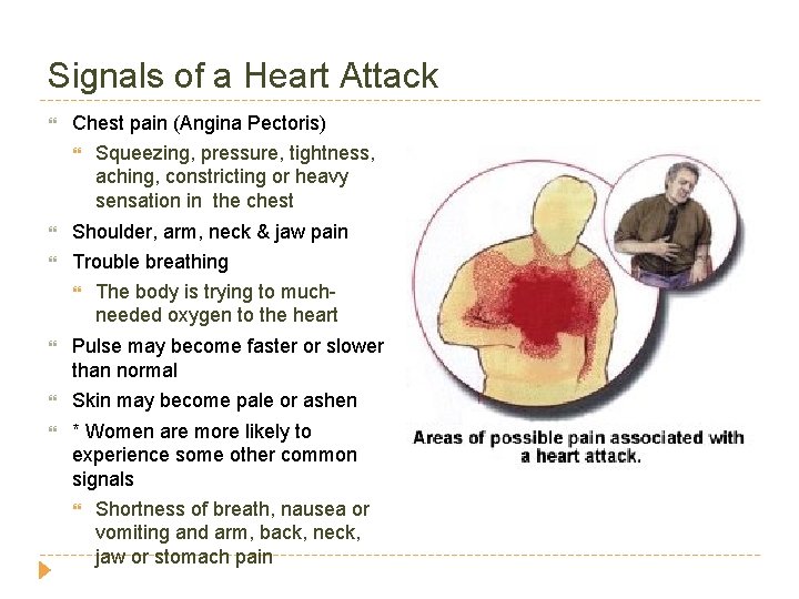 Signals of a Heart Attack Chest pain (Angina Pectoris) Squeezing, pressure, tightness, aching, constricting