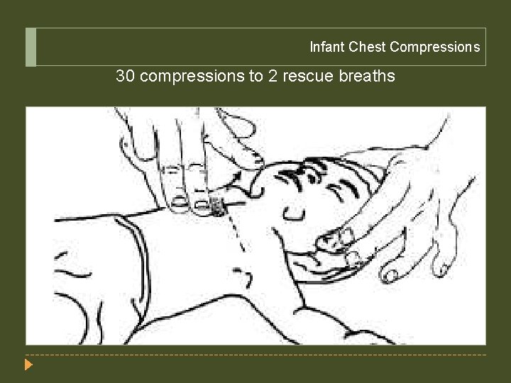 Infant Chest Compressions 30 compressions to 2 rescue breaths 