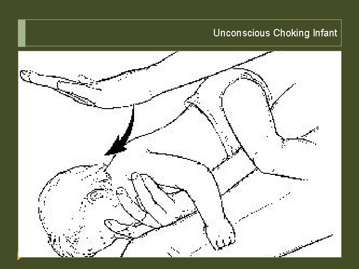 Unconscious Choking Infant 