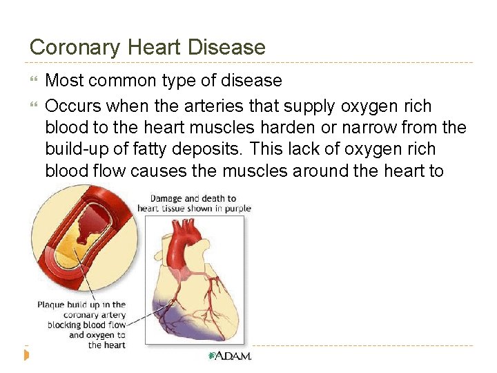 Coronary Heart Disease Most common type of disease Occurs when the arteries that supply
