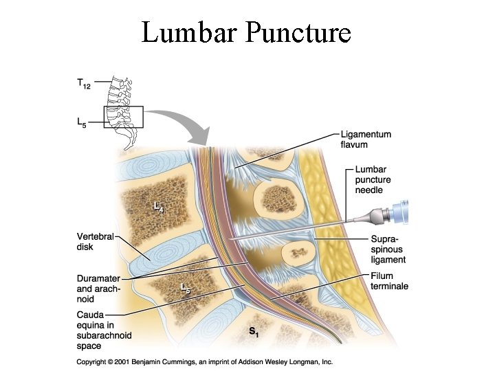Lumbar Puncture 