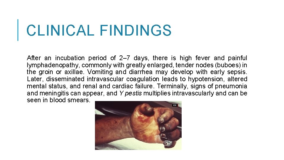 CLINICAL FINDINGS After an incubation period of 2– 7 days, there is high fever