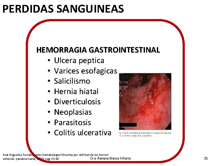 PERDIDAS SANGUINEAS HEMORRAGIA GASTROINTESTINAL • Ulcera peptica • Varices esofagicas • Salicilismo • Hernia