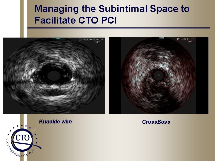 Managing the Subintimal Space to Facilitate CTO PCI Knuckle wire Cross. Boss 