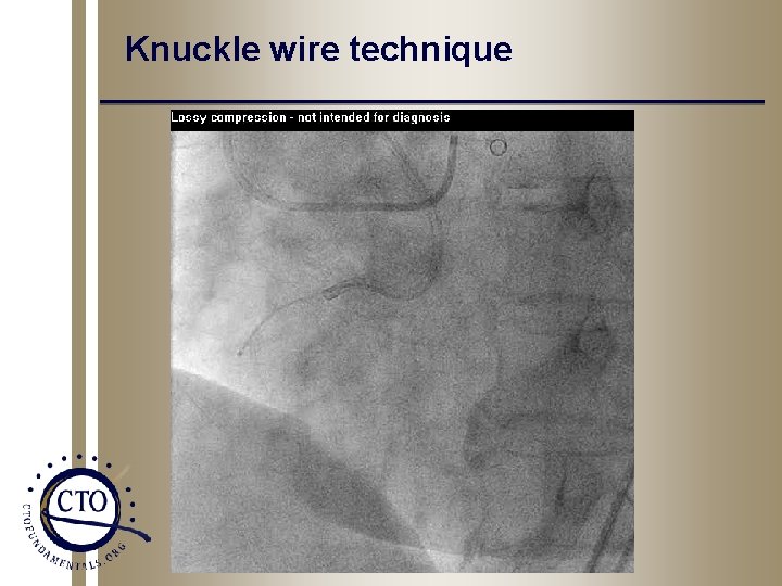 Knuckle wire technique 