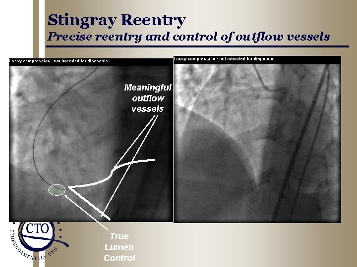 Stingray Reentry Precise reentry and control of outflow vessels Meaningful outflow vessels True Lumen