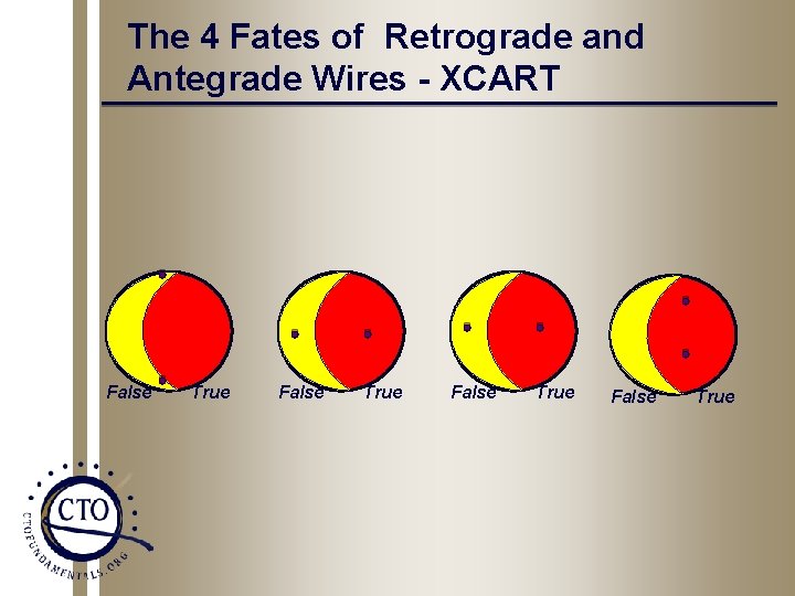The 4 Fates of Retrograde and Antegrade Wires - XCART False True 