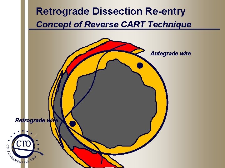 Retrograde Dissection Re-entry Concept of Reverse CART Technique Antegrade wire Retrograde wire 