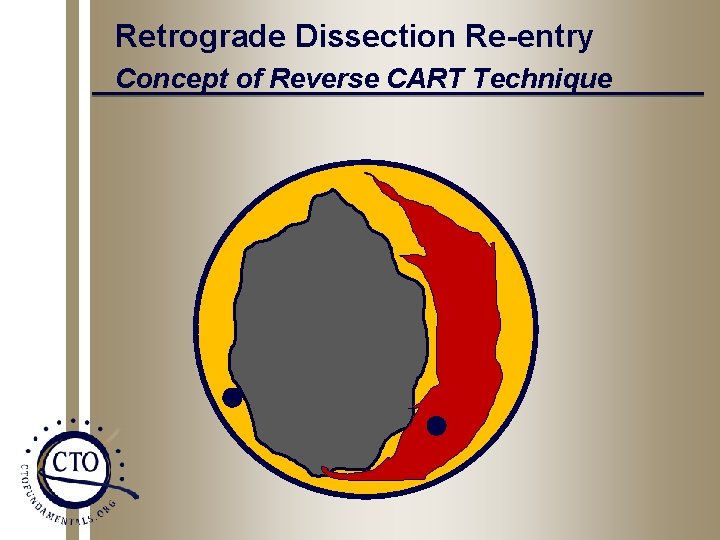 Retrograde Dissection Re-entry Concept of Reverse CART Technique 