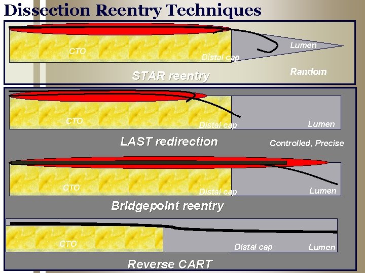 Dissection Reentry Techniques CTO Lumen Distal cap Random STAR reentry CTO LAST redirection CTO