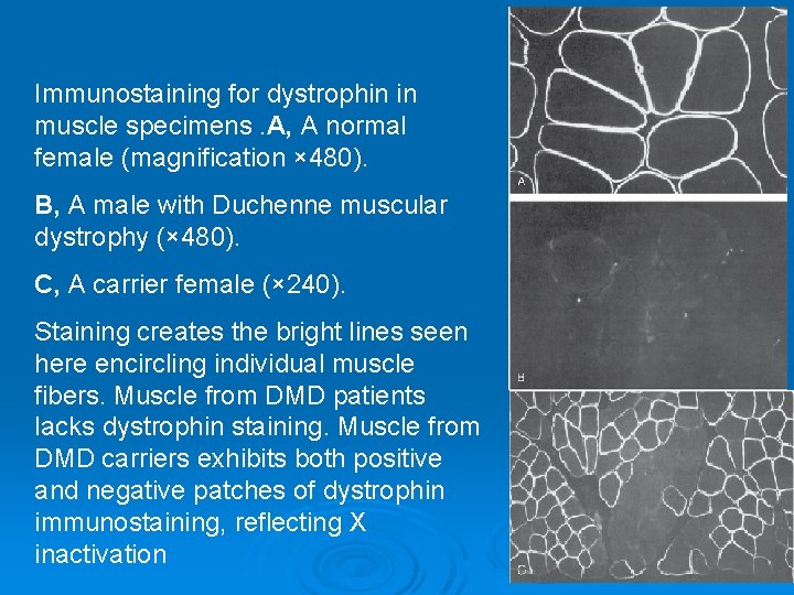 Immunostaining for dystrophin in muscle specimens. A, A normal female (magnification × 480). B,