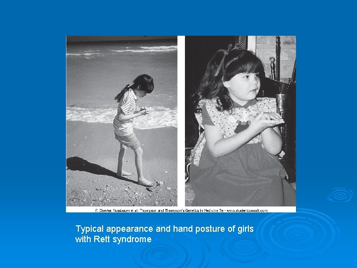 Typical appearance and hand posture of girls with Rett syndrome 