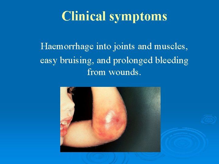 Clinical symptoms Haemorrhage into joints and muscles, easy bruising, and prolonged bleeding from wounds.