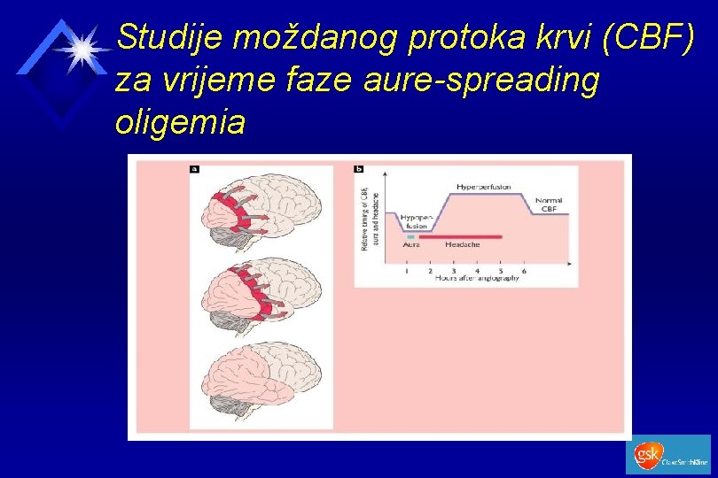 Studije moždanog protoka krvi (CBF) za vrijeme faze aure-spreading oligemia 