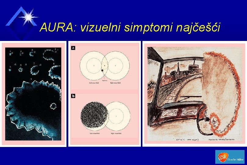 AURA: vizuelni simptomi najčešći 