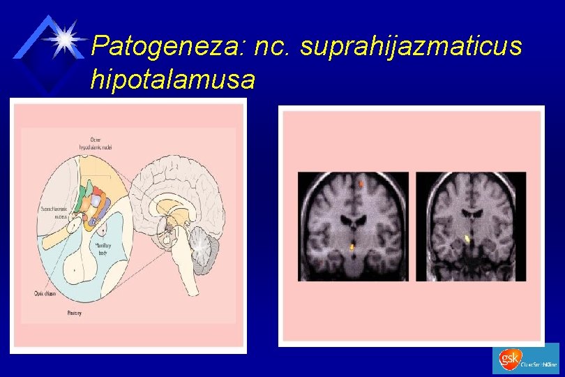 Patogeneza: nc. suprahijazmaticus hipotalamusa 