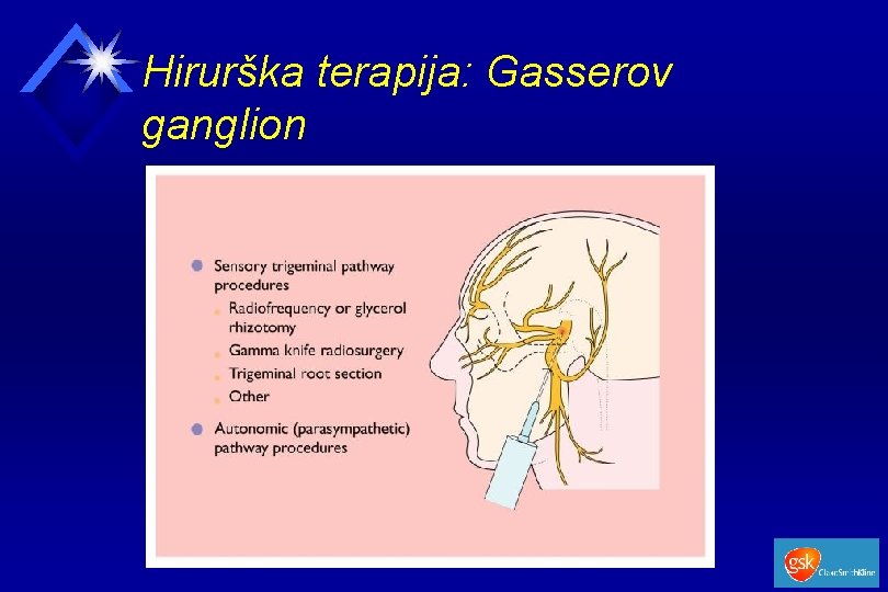 Hirurška terapija: Gasserov ganglion 