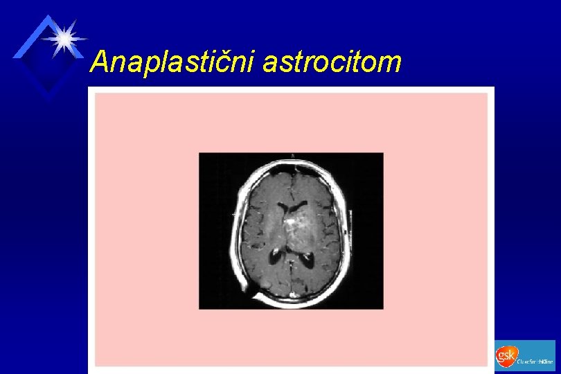 Anaplastični astrocitom 