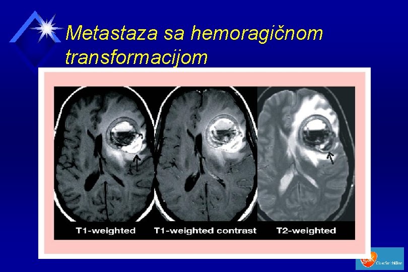 Metastaza sa hemoragičnom transformacijom 