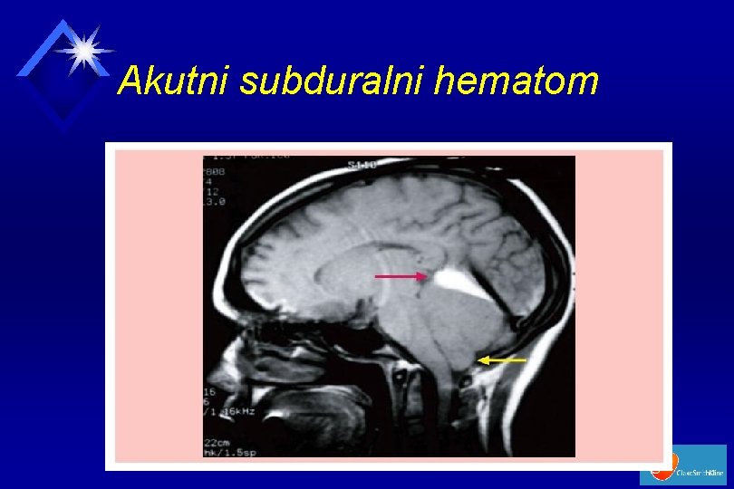 Akutni subduralni hematom 