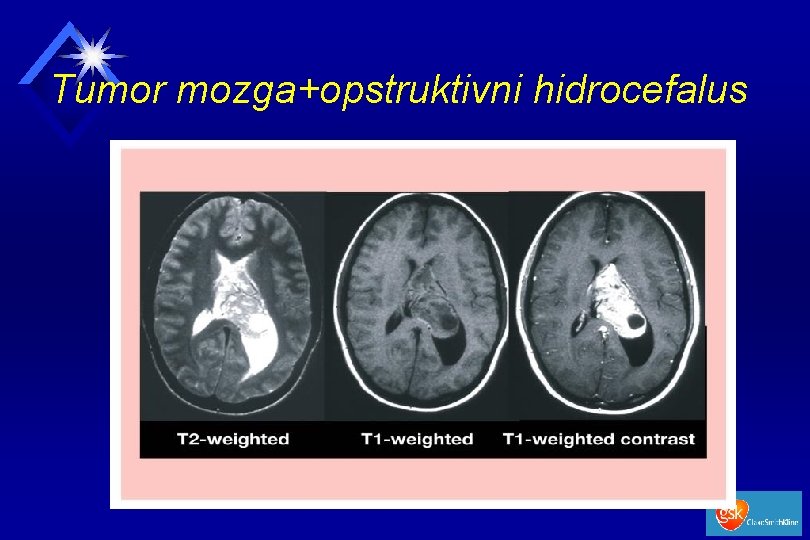 Tumor mozga+opstruktivni hidrocefalus 