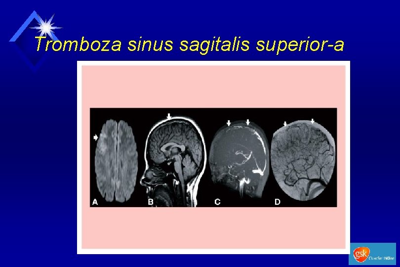 Tromboza sinus sagitalis superior-a 