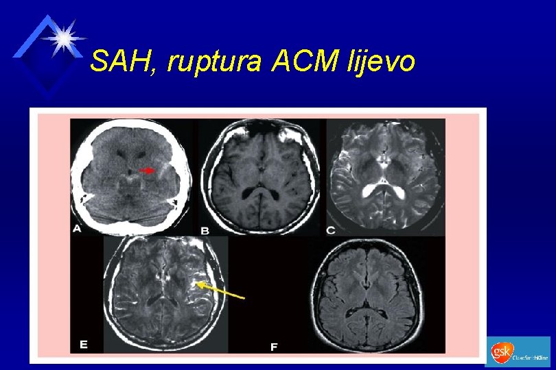 SAH, ruptura ACM lijevo 