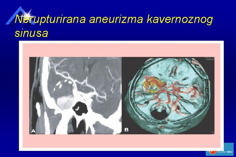 Nerupturirana aneurizma kavernoznog sinusa 
