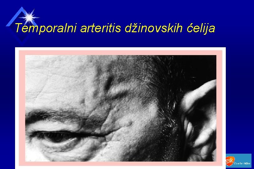 Temporalni arteritis džinovskih ćelija 