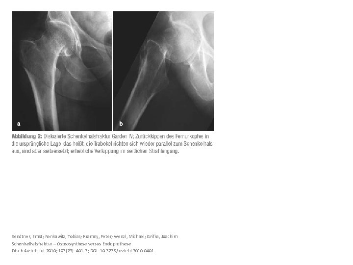 Sendtner, Ernst; Renkawitz, Tobias; Kramny, Peter; Wenzl, Michael; Grifka, Joachim Schenkelhalsfraktur – Osteosynthese versus