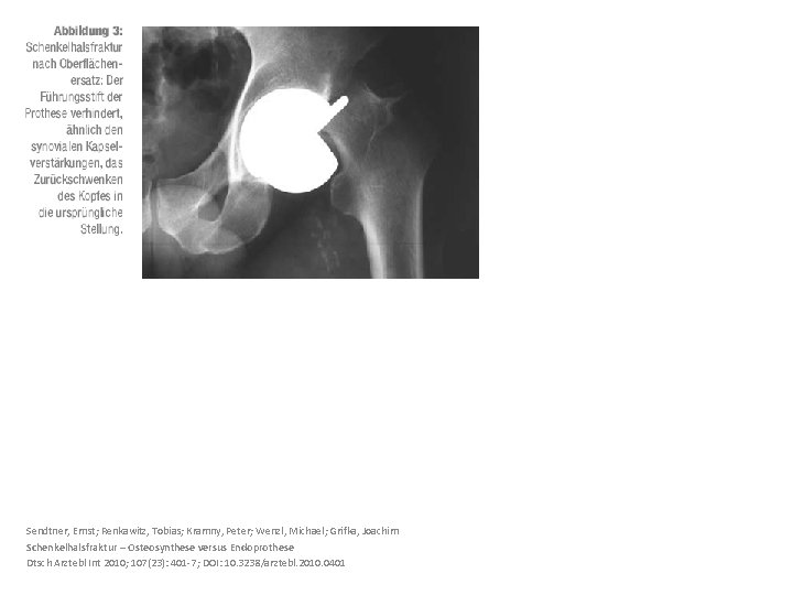 Sendtner, Ernst; Renkawitz, Tobias; Kramny, Peter; Wenzl, Michael; Grifka, Joachim Schenkelhalsfraktur – Osteosynthese versus
