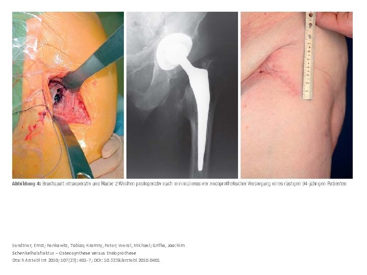 Sendtner, Ernst; Renkawitz, Tobias; Kramny, Peter; Wenzl, Michael; Grifka, Joachim Schenkelhalsfraktur – Osteosynthese versus